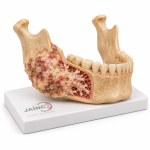 Oesteosacoma of Mandible Model